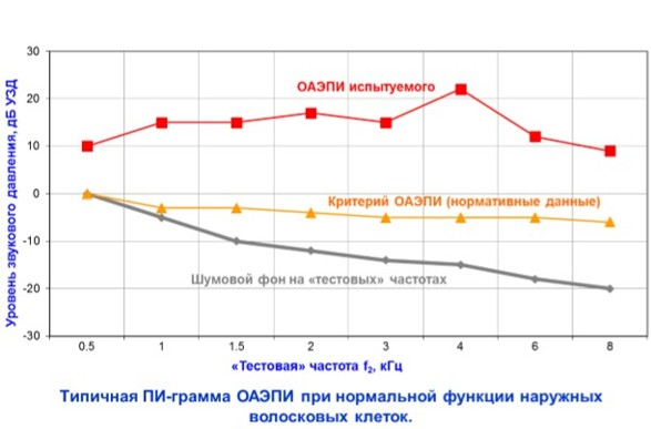 Диагностика с помощью отоакустической эмиссии-2